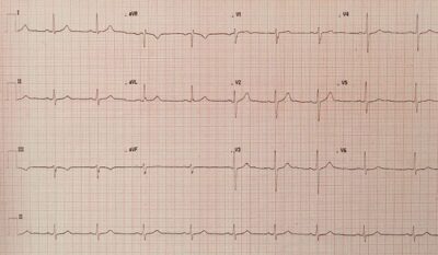 Four Reasons your doctor might request an ECG