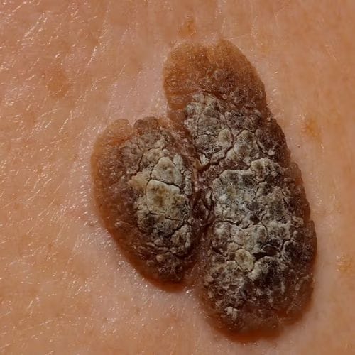 seborrheic keratosis