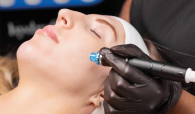 Microneedling