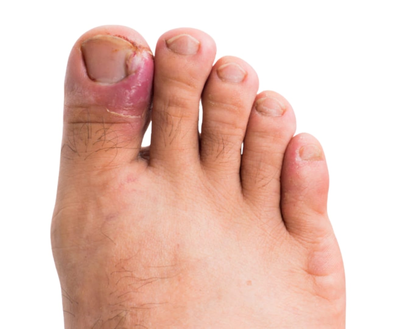 Infected or In-grown Toenails