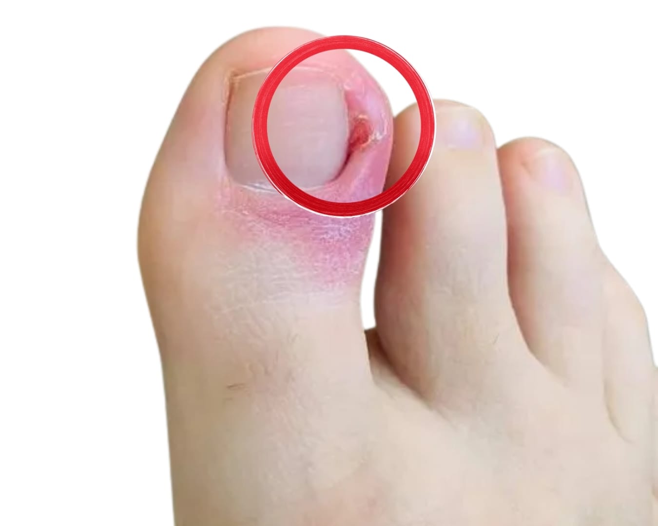 Ingrown Toenails
