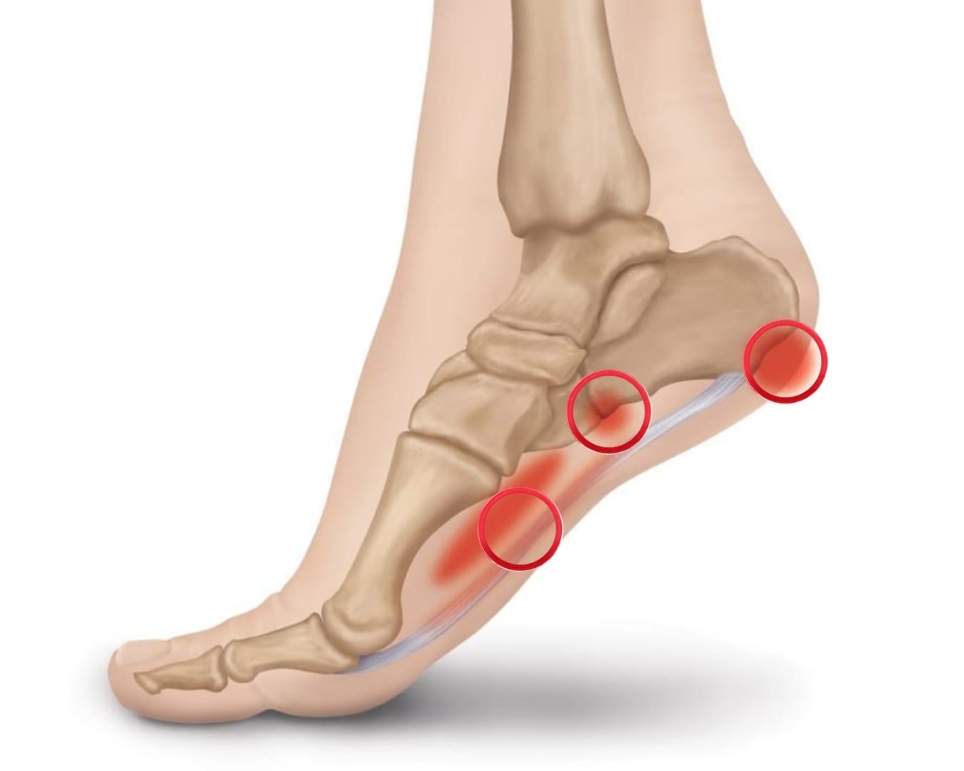Plantar Fasciitis (1)
