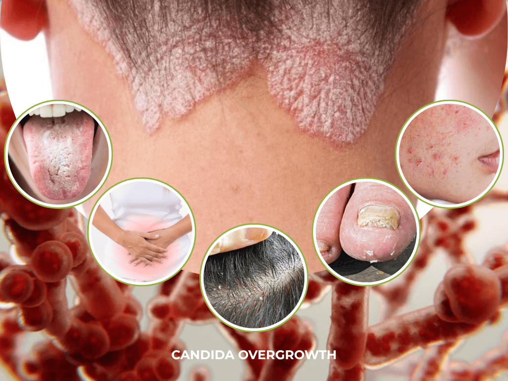 Candida Overgrowth