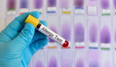 ALEX² Molecular Allergy Testing