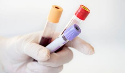 Blood tests before an iron infusion: what you need (and when to repeat)