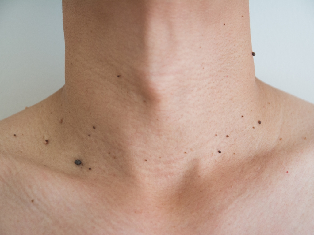 Skin tags