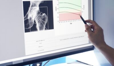 Protecting muscle and bone during weight loss on GLP-1 medication